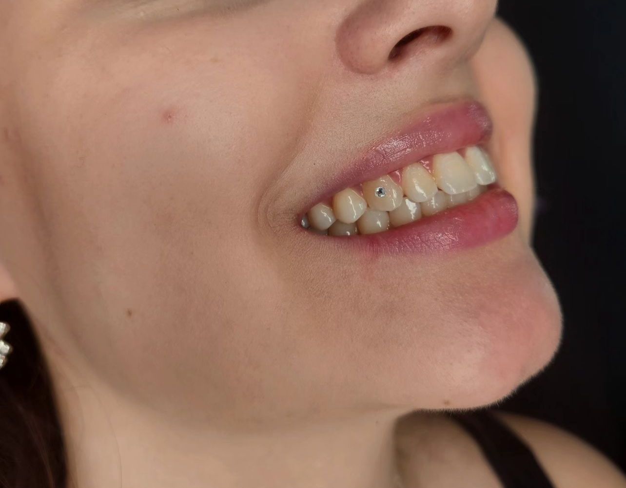 A tooth gem applied at Perfect Image 